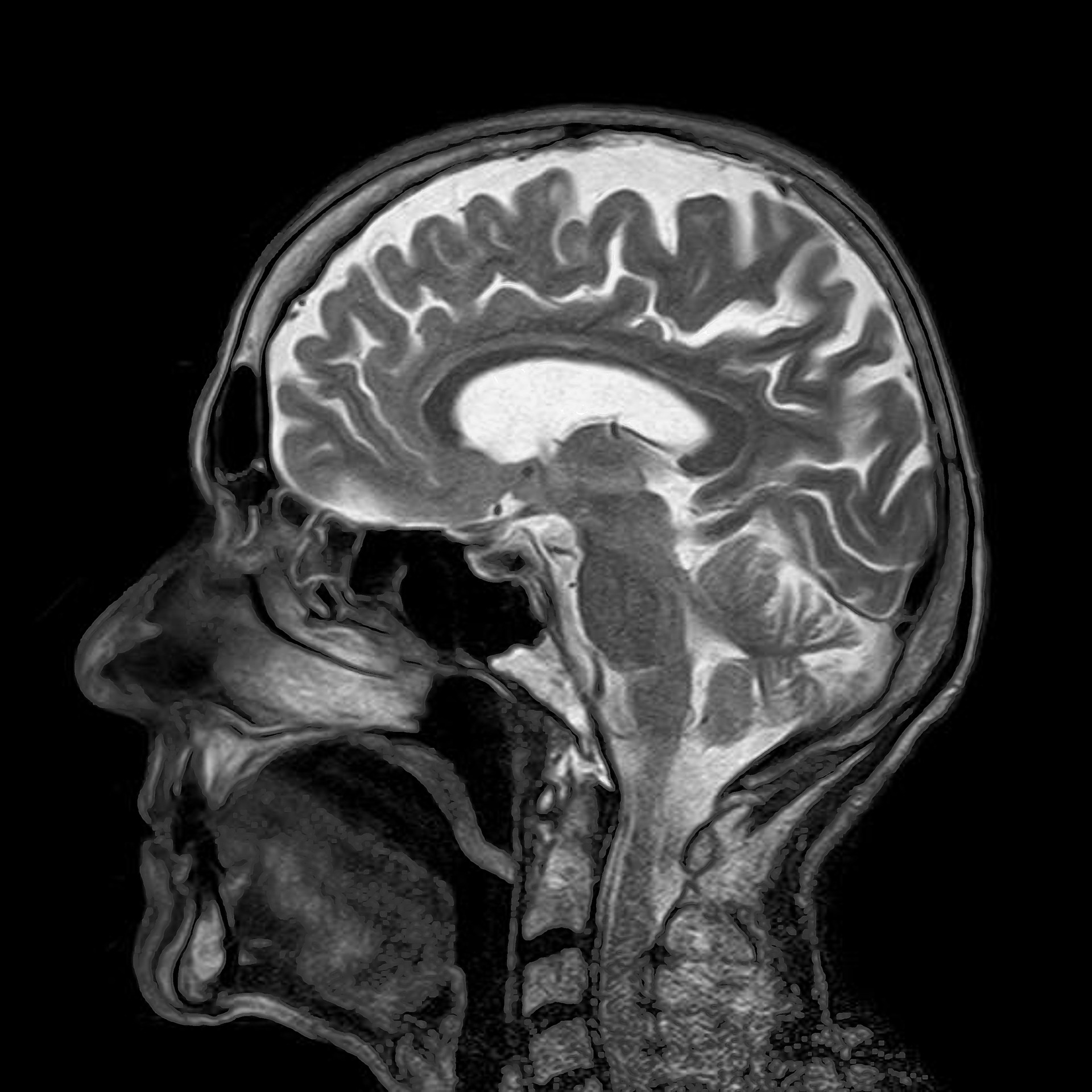 MRI representing Addiction as a Brain Disease